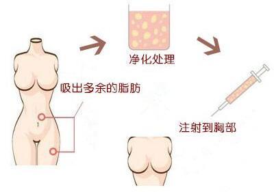 北京做自体脂肪隆胸哪家医院好？价格需要多少？