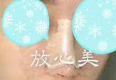 湖南省人民医院整形激光美容中心做鼻部整形手术贵吗 