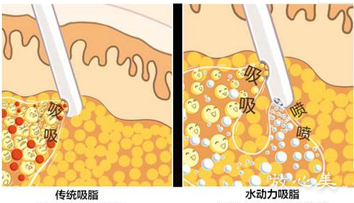 湘雅医院整形臀部减肥费用表全新改版公布！