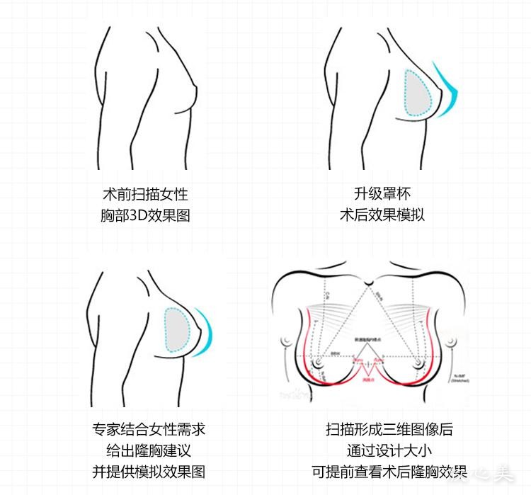 深圳市第二人民医院烧伤整形科做自体脂肪隆胸技术怎么样？